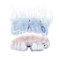 Dental implantology software SIMPLANT®for dental implant simulationplanning