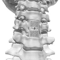 Cervical vertebral corpectomy prosthesis F3D3D-printed