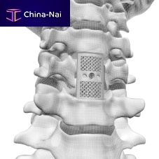 Cervical vertebral corpectomy prosthesis F3D3D-printed