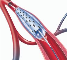 PTA catheter PolarCath sub-popliteal arteryfemoral arteryiliac artery