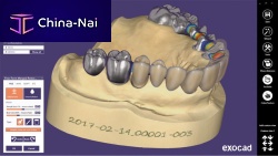 CAD software exocad ®clinicaldentalfor dental imaging