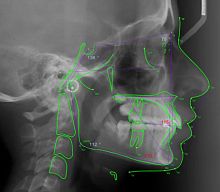 Medical software Romexis®orthodonticsurgicalcephalometric analysis