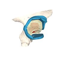Hip prosthesis resection guide