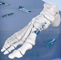 Hallux valgus osteotomy plate A-TEC metatarsophalangeal jointlockingmetallic