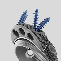 Revision acetabular prosthesis Structan® cementless