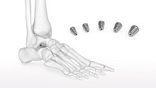 Subtalar joint implant Talar-Fit