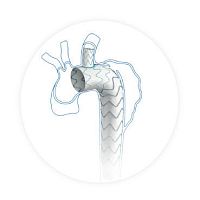 Aortic arch stent graft Castornitinolpolyethylene