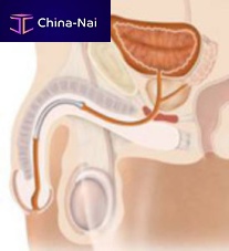 Urethral stent Memokath 044, Memokath 045nitinol