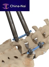 Minimally invasive pedicle screw positioning system Invictus