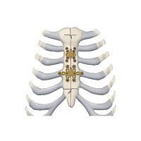 Rib arthrodesis plate 460 seriessternumlockingtitanium