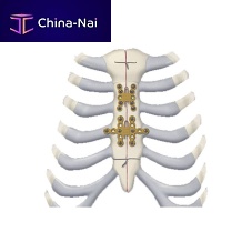 Rib arthrodesis plate 460 seriessternumlockingtitanium