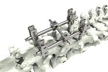 Thoracic-lumbar vertebra pedicle screw M10-Iapolyaxialmonoaxialtitanium