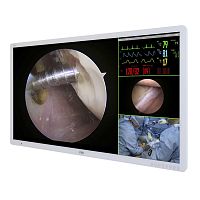Diagnostic display Medical Monitordentallaparoscopyfor hysteroscopy