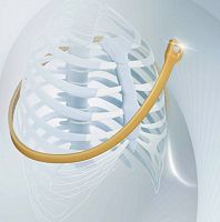 Sternal closure bone cerclage wiring SternoEaZip®monofilament polymer