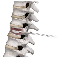 Needle spine augmentation system AFFIRM®percutaneous vertebroplasty