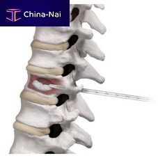 Needle spine augmentation system AFFIRM®percutaneous vertebroplasty