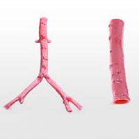 Iliac artery vascular bioprosthesis CryoArtery®allografttwo-branch