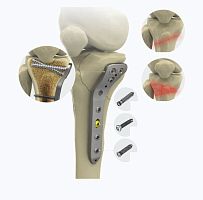 Proximal compression plate 1572 seriestibiamediallocking