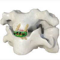 Cervical interbody fusion cage 0-Panteriorwith cervical bone plate