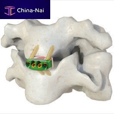 Cervical interbody fusion cage 0-Panteriorwith cervical bone plate