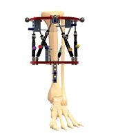 Tibia external fixation system ORTHEXcircularpediatric