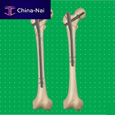 Femoral intramedullary nail Neonproximal fixationtitanium
