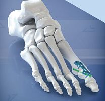 Hallux valgus arthrodesis plate 400108 seriesforefootlockingtitanium
