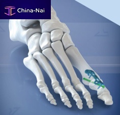 Hallux valgus arthrodesis plate 400108 seriesforefootlockingtitanium